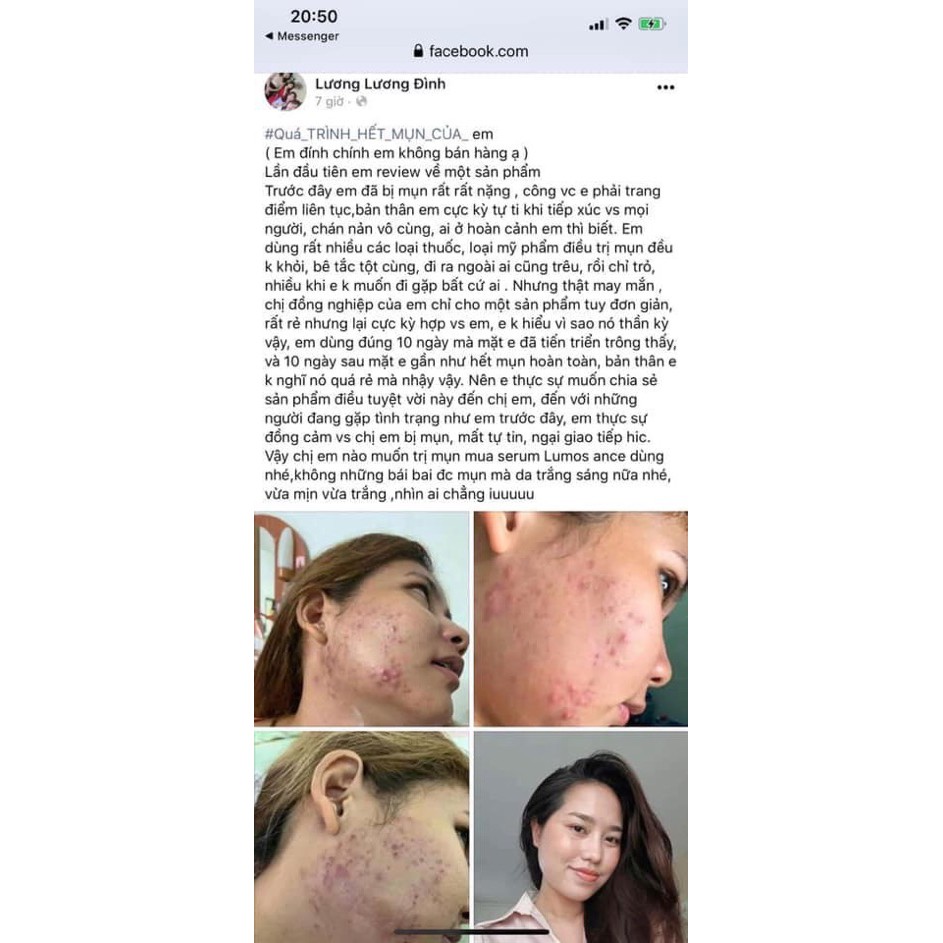 Serum mụn Lumos Ance, sạch mụn, mờ thâm dưỡng trắng da mặt