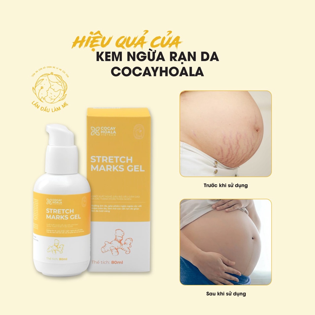 Kem Ngừa Rạn Da Gel Nghệ Cocayhoala- Ngăn Ngừa Và Làm Giảm Rạn Da Khi Mang Thai, Làm Mờ Vết Thâm 80ml