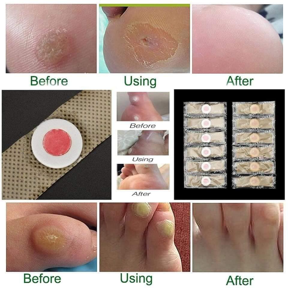 Miếng dán Giảm mụn cóc, mụn cơm, trai chân, cực kì hiệu quả. | BigBuy360 - bigbuy360.vn