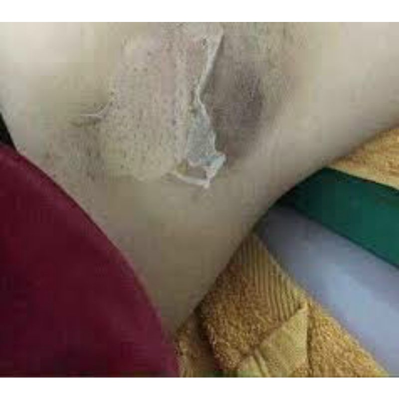 Peel Lột Nách Hết Thâm Sạm Trắng Da