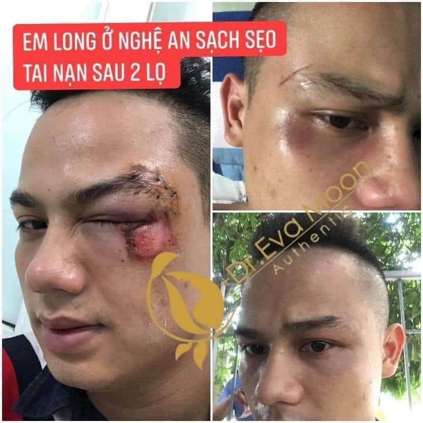 "GIÁ SỐC" Kem sẹo rỗ, sẹo thâm, sẹo rạn , sẹo thủy đậu