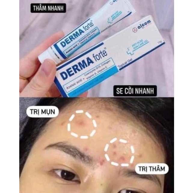 Kem Derma forte cho làn da mụn 15g