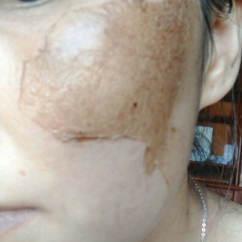 Combo phân giải nám mảng, tái tạo da Handmade