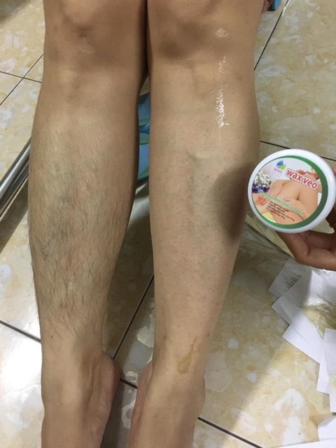 Combo triệt lông Wax veo và Mỡ trăn | BigBuy360 - bigbuy360.vn