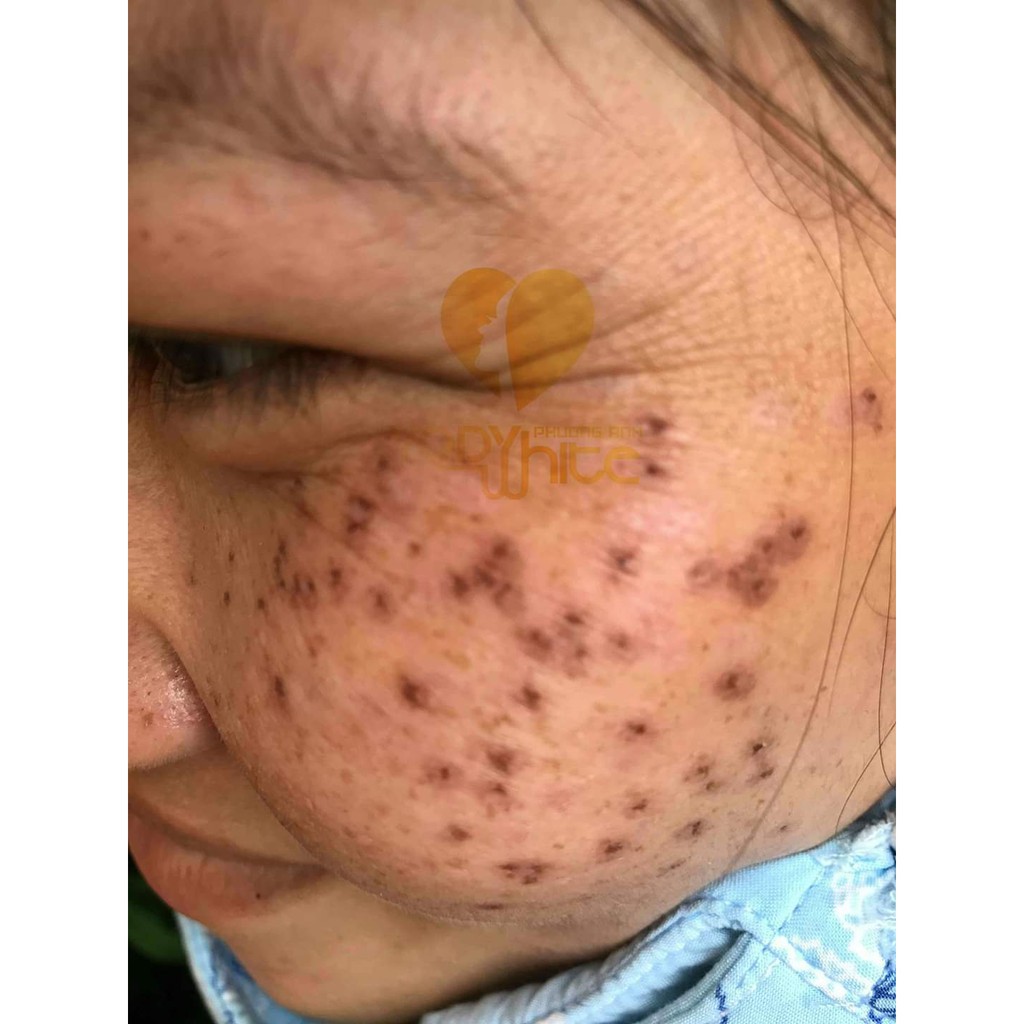 Serum Chấm tàn nhang Yody White Phương Anh dùng cho tàn nhang, nốt ruồi, đốm nâu, sẹo lồi