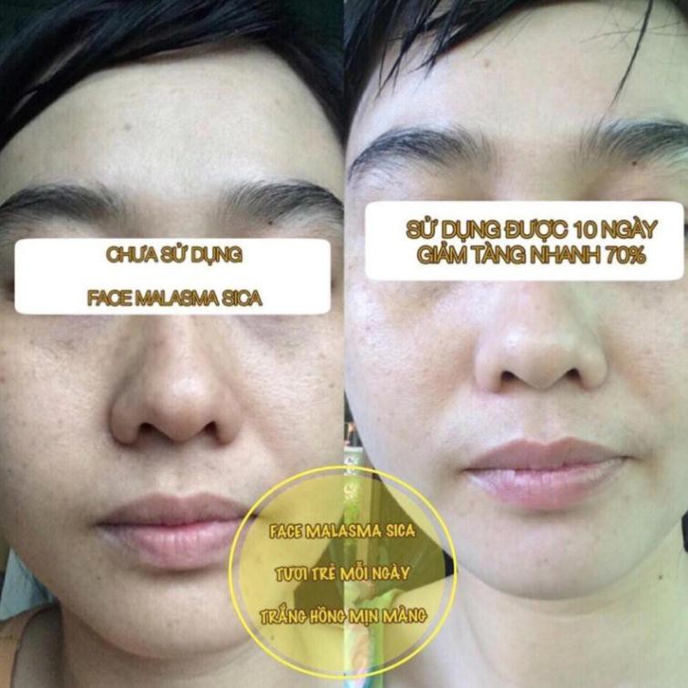 Face Melasma - Kem Nám Vip