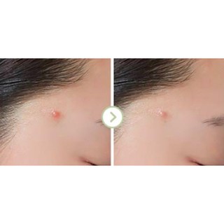 MBC Tinh dầu tea tree chấm mụn APIEU Nonco Tea Tree Oil