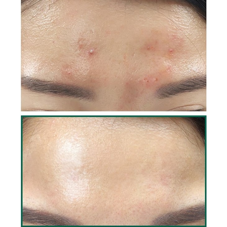 Nước hoa hồng hỗ trợ làm sạch mụn some by mi aha bha pha 30 days miracle toner 150ml skin hub | BigBuy360 - bigbuy360.vn