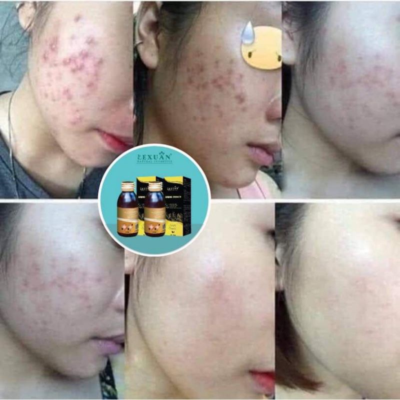 Thảo Dược Đông Y Lê Xuân🍒Trắng Da-Kiềm dầu-Mờ Thâm Nám | BigBuy360 - bigbuy360.vn