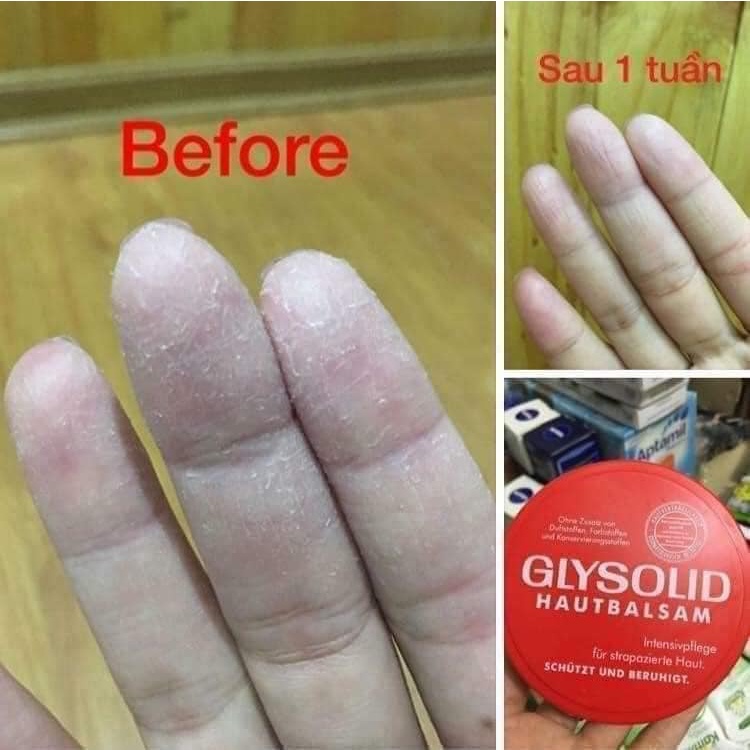 Kem bôi nẻ GLYSOLID ĐỨC