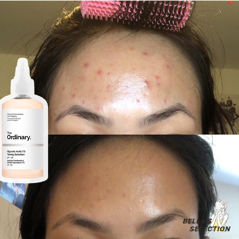 Toner tẩy da chết làm sạch Glycolic Acid 7% Toning Solution - The Ordinary | BigBuy360 - bigbuy360.vn