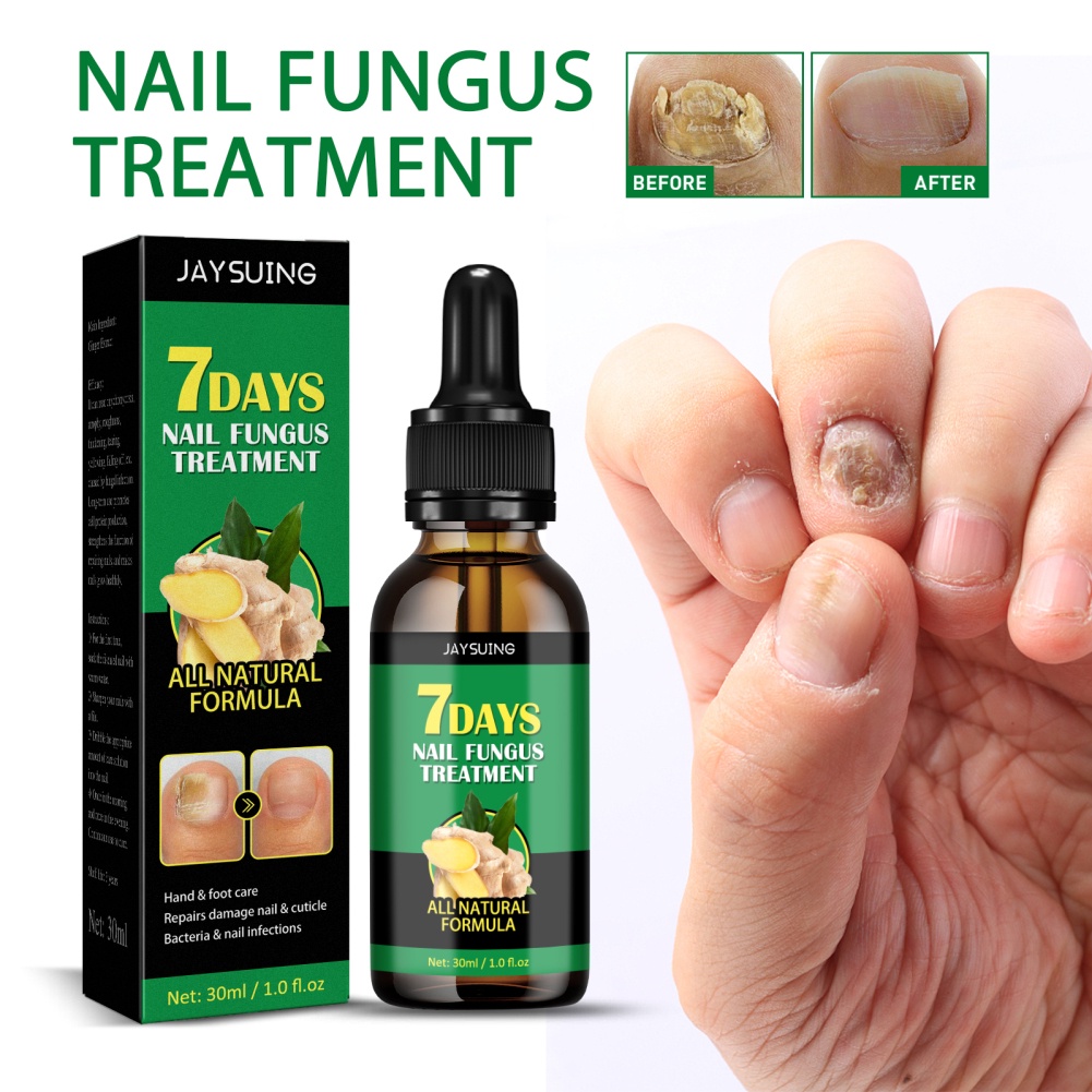 Tinh chất JULYSTAR gừng 7 ngày loại bỏ nấm/ chống nhiễm trùng chăm sóc móng tay/ chân