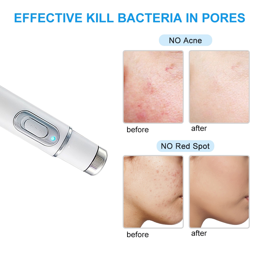 Bút laser xóa nếp nhăn và hỗ trợ giảm mụn