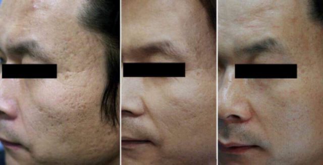 Tế bào gốc làm đầy sẹo lõm Scar Control date T10/2024