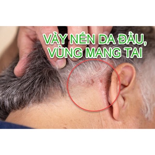THẢO DƯỢC BÔI NẤM, VẢY NẾN DA ĐẦU - VÙNG MANG TAI [ CỰC HIỆU QUẢ ] HẾT SẠCH NẤM_HÀNG SẴN CÓ