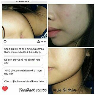 Kem Trị Thâm Handmade