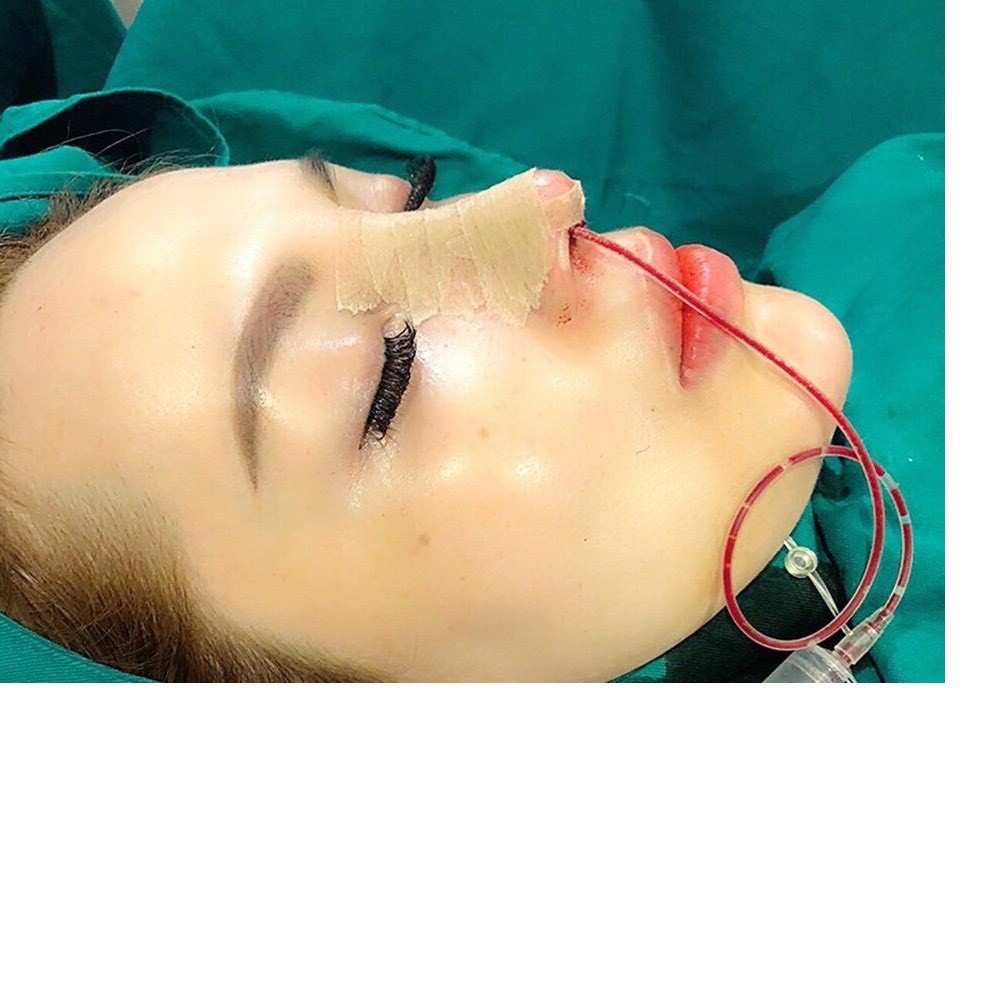 Dây dẫn dịch mũi thẩm mỹ vô trùng