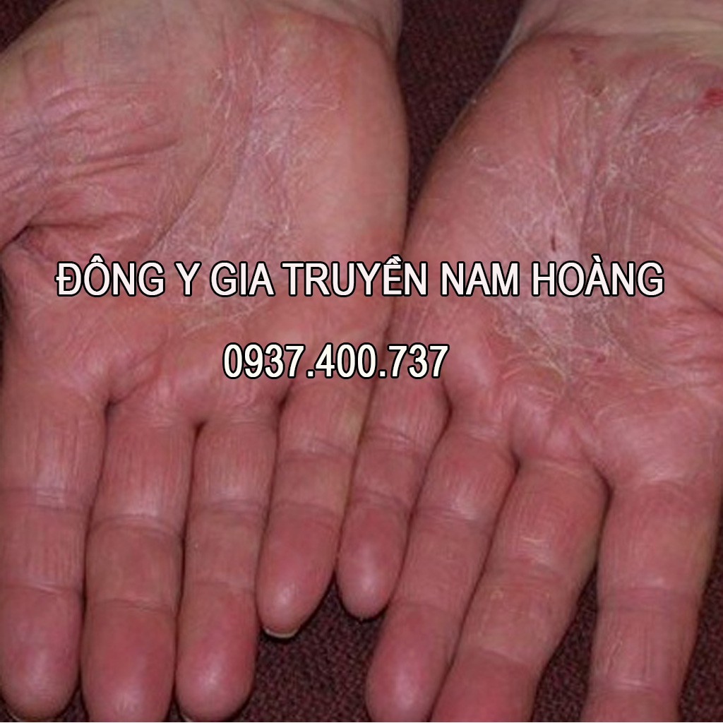 Dược Phẩm Bôi Hắc Lào, Nấm Ngứa, Á Sừng, Lang Ben Nam Hoàng