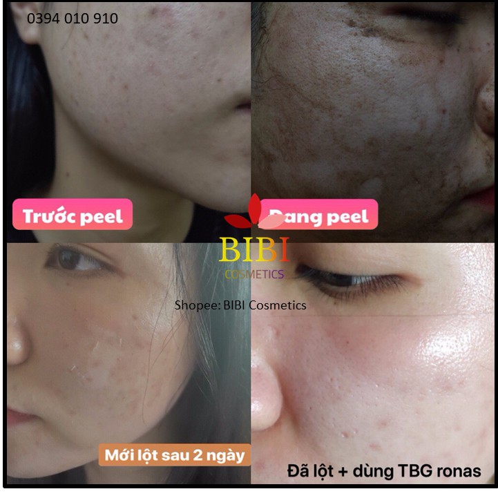 (TÁCH SET+ FILE HƯỚNG DẪN) VI TẢO BIỂN PEEL DA RONAS RESTING PEEL KÈM DỊCH CHÍNH HÃNG KOREA