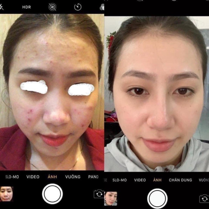 Serum Diếp Cá handmade - giảm mụn, thâm, dưỡng da căng bóng | BigBuy360 - bigbuy360.vn
