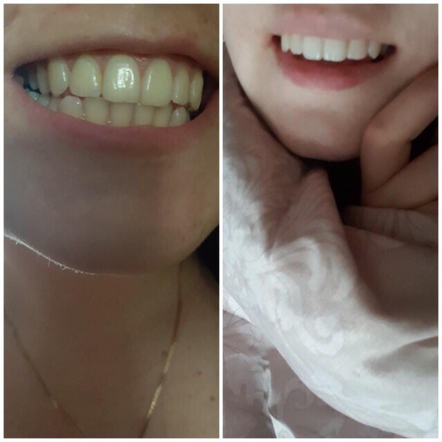 Miếng dán trắng răng hiệu quả nhanh Whitening Strip Advanced hộp 7 gói gồm 14 miếng