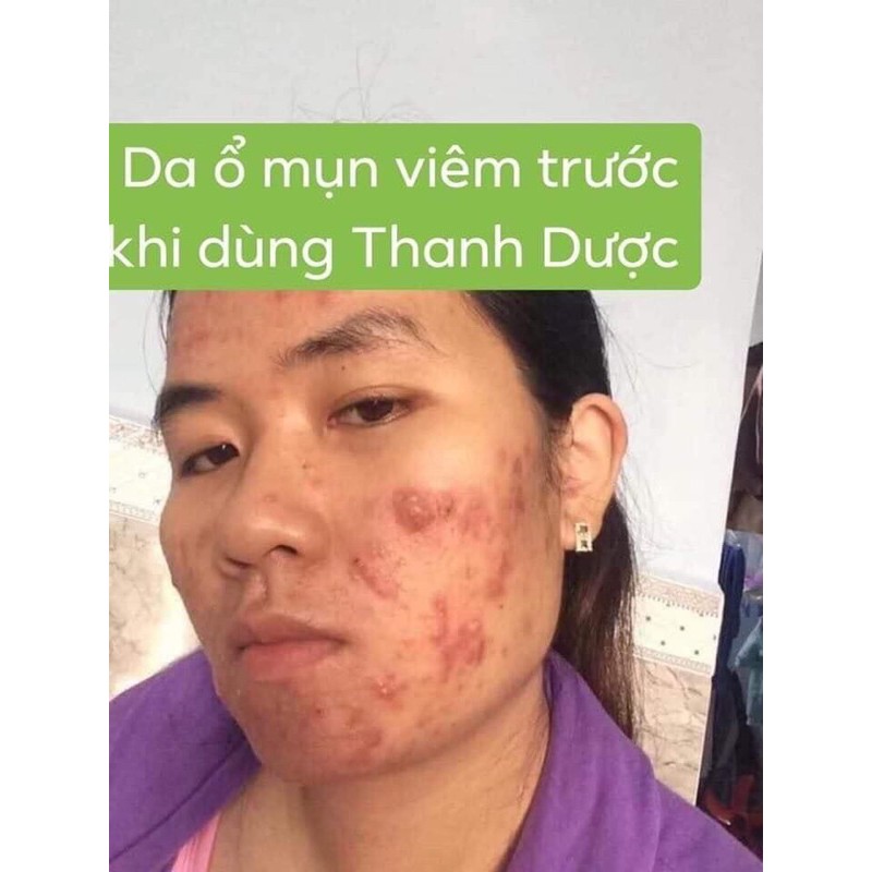 [SIZE 40ML] SERUM THANH DƯỢC - LÁRE THẢO DƯỢC ĐIỀU TRỊ DA | BigBuy360 - bigbuy360.vn