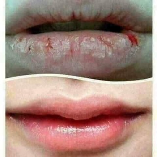 VASELINE viện bỏng quốc gia