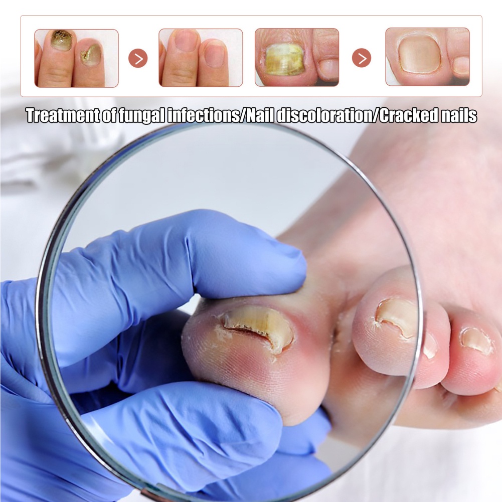 ♕Nam Trung Thu Móng Chân Sửa Chữa Chất Lỏng Onychomycosis Tay Và Chân Móng Tay Va Sửa Chữa Chất Lỏng Mịn Móng Dày Mềm Mại Móng Tay Chăm Sóc Móng Tay