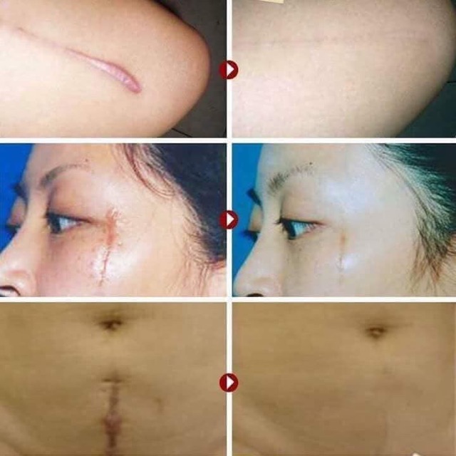 Kem sẹo Gentacin Nhật Bản 10gr