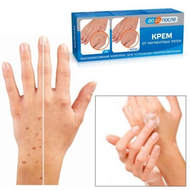 Kem đồi mồi tay Nga, Kem Dưỡng Giúp Mờ Và Hồi Phục Các Đóm Đồi Mồi, Nám, Tàn Nhan Kpem 50ml
