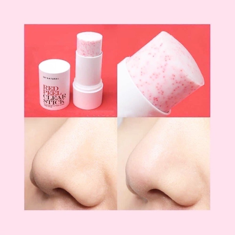 THANH LĂN MỤN ĐẦU ĐEN RED PEEL HÀN QUỐC