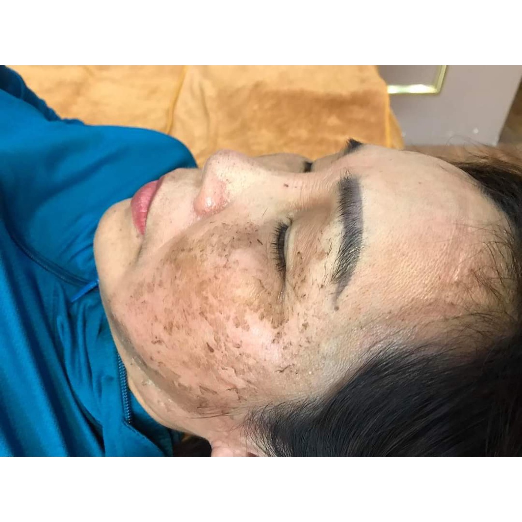 Hút nám dịu nhẹ, lành tính giúp tái tạo da, sáng da, thải độc tố, giảm thâm, mờ nám spa