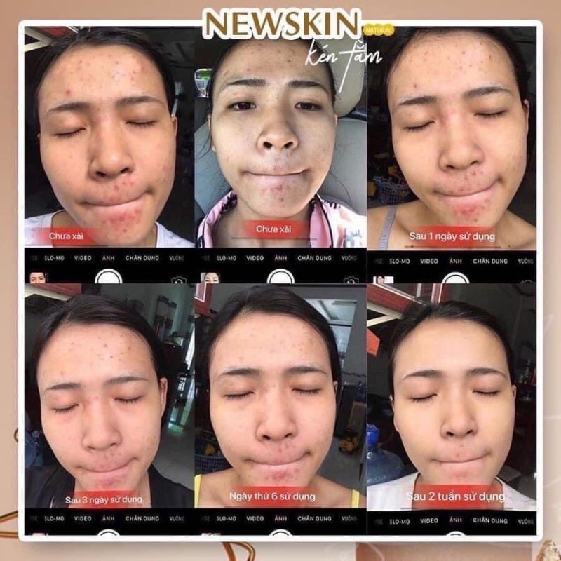 Newskin Dưỡng Da sạch mụn thâm