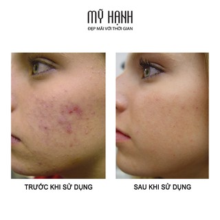ACNE TREATMENT | SERUM MỤN NGHỆ PRISWHITE