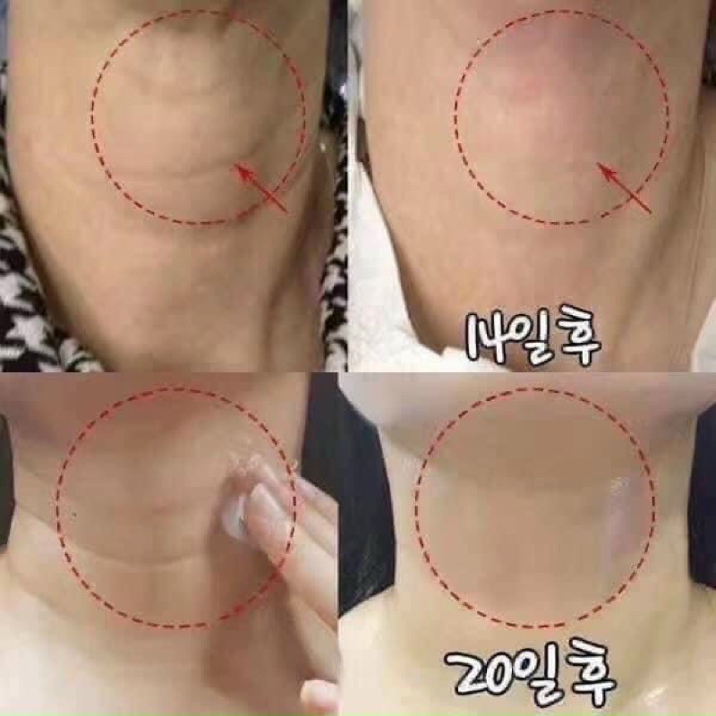 Kem Dưỡng Da Cổ Ngăn Ngừa Lão Hoá, Nếp Nhăn Làm Săn Chắc Da Vùng Cổ Medi Peel Naite Thread Neck Cream 100ml