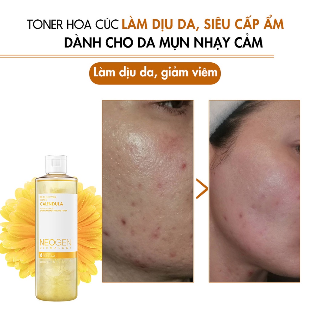 Toner Hoa Cúc Làm Dịu Da, Siêu Cấp Ẩm Cho Da Mụn Neogen Dermalogy Real Flower Toner CALENDULA 300ml