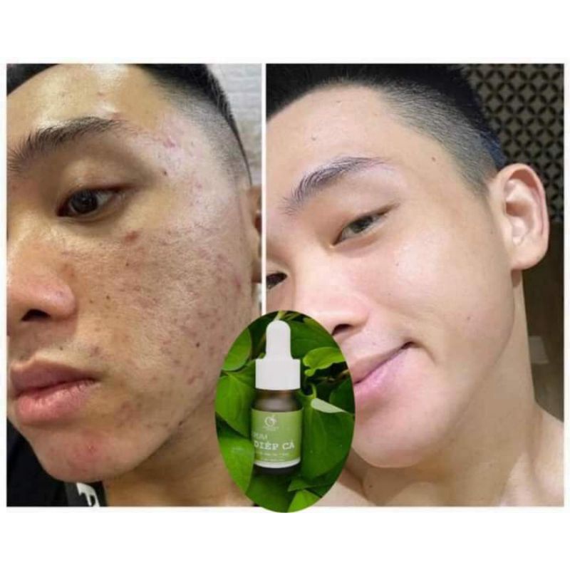 Serum dưỡng da chính hãng IGREEN 10ml chiết xuất từ diếp cá giảm mờ thâm sáng da không gây kích ứng