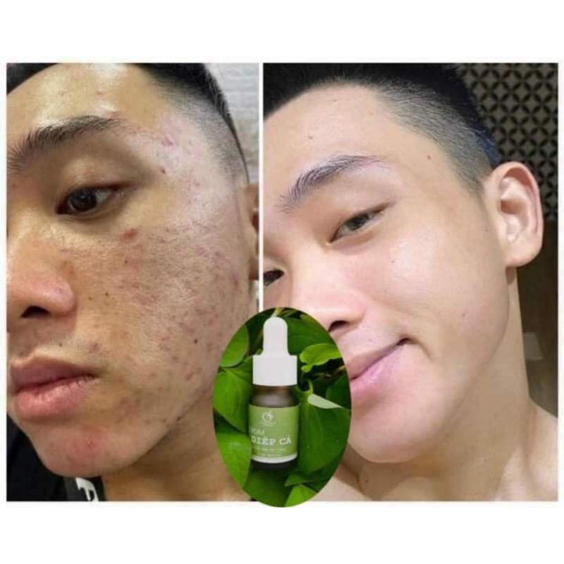 Serum GIẢM MỤN, GIẢM THÂM, SE KHÍT LỖ CHÂN LÔNG, SÁNG DA - Serum Diếp Cá IGREEN