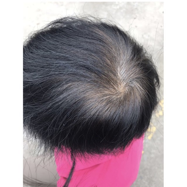 Tóc giả che hói đỉnh đầu- mẫu có đưỡng rãnh da đầu