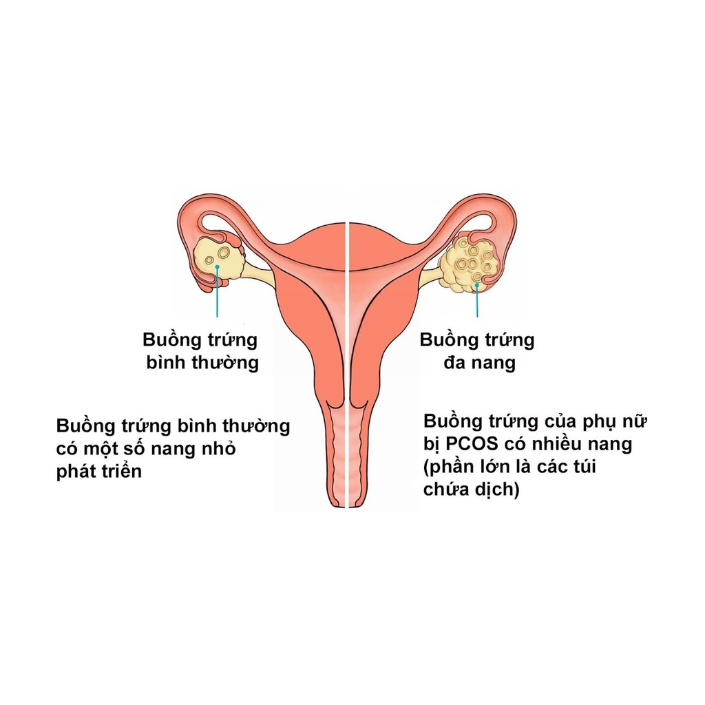 Pregnasitol - hỗ trợ mang thai ở nữ giới