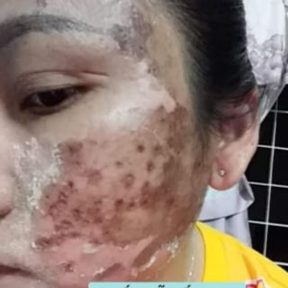 SÉT NHỎ PEEL TCA USA