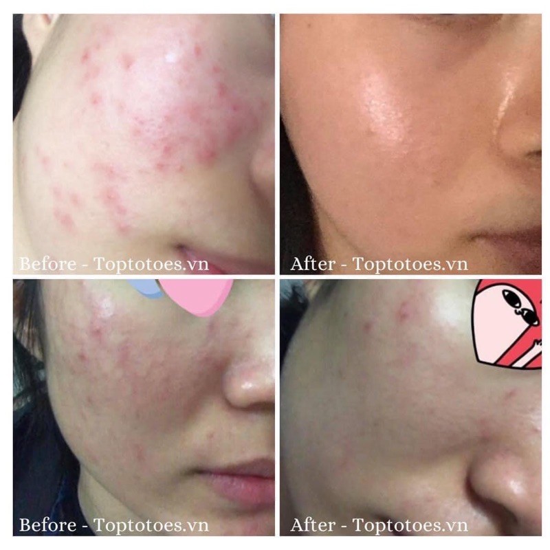 Serum Teana Super Peptides Anti-redness giảm sưng viêm, mẩn đỏ, mụn, phục hồi da