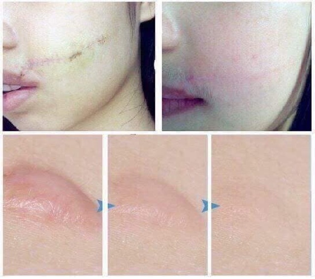Kem sẹo Gentacin Nhật Bản 10gr