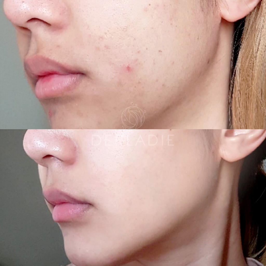 Nước Hoa Hồng Tràm Trà Giảm Mụn Derladie Herbal Extract Toner 140ml