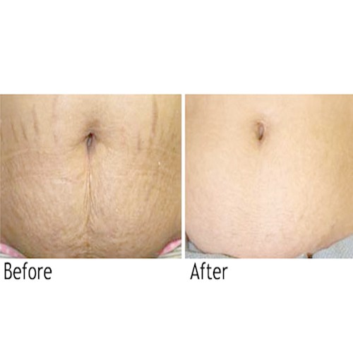 Kem xóa rạn da PURE LINE - Giúp làm mờ vết rạn da và tan mỡ bụng đến 97% của Nga