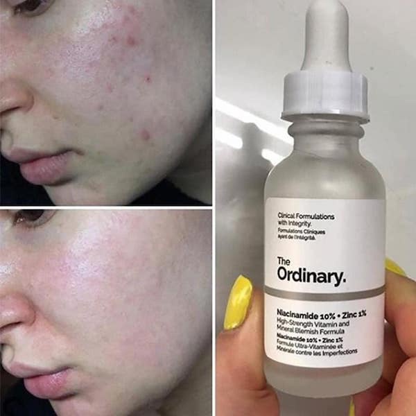 Tinh chất The Ordinary Niacinamide 10% + Zinc 1% giảm mụn giảm thâm 30ml