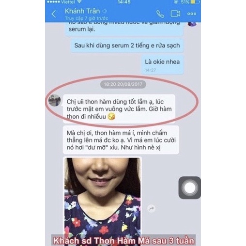 Tinh chất thu xương hàm má Miracle, hiệu quả chỉ sau 14 ngày