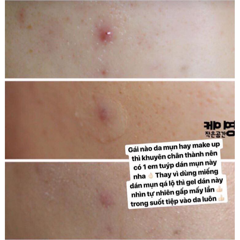 Gel Dán Mụn Second Skin Pacth Prreti | BigBuy360 - bigbuy360.vn