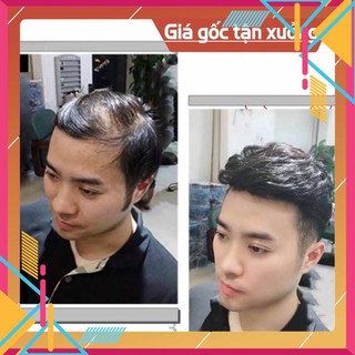 Mái hói nam dạng dán / kẹp siêu da đầu 100%