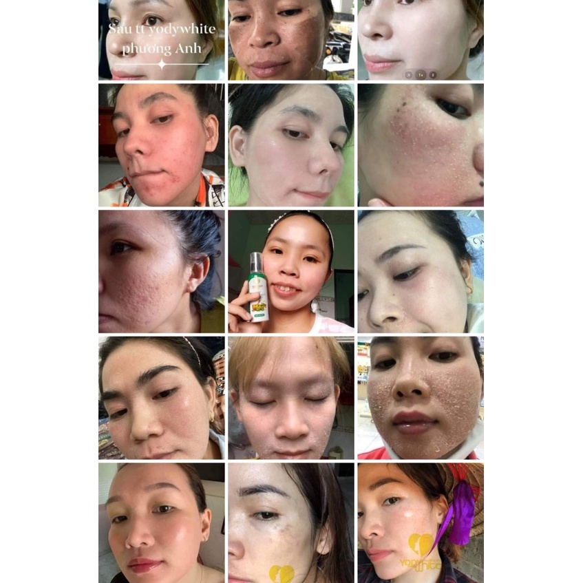 Combo tái tạo da mặt Phương Anh chuyên mụn nám rỗ tàn nhang